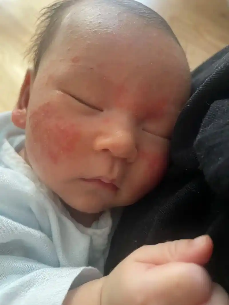 记录宝宝湿疹过程.4.26 宝宝脸上开始长疹子,不到一周满脸 - 抖音