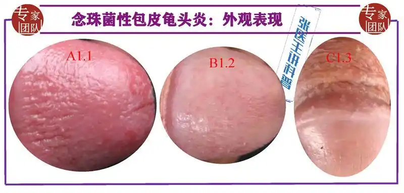 包皮龟头炎