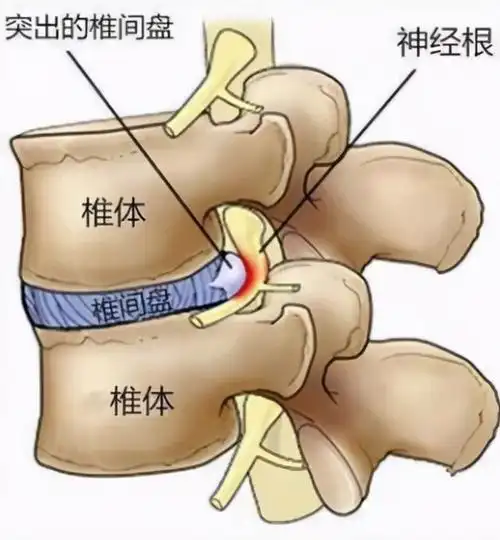 腰椎间盘突出症80%-90%不需要手术,可以这样治.