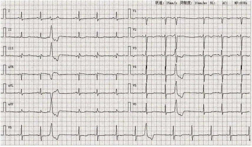 心电图图库室性早搏系列