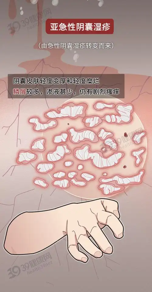 急性期,亚急性期和慢性期阴囊湿疹可以分为三期按皮肤损害的表现而且