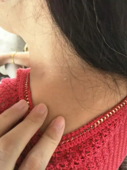 这个脖子后面的小白包是什么东西啊 有影响么