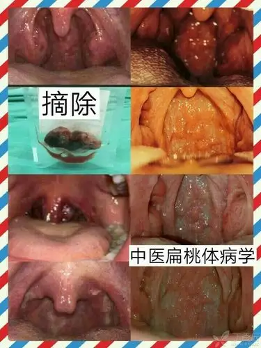 轻的可经3~5天治疗后,将有80%左右在下次感冒时扁桃体无红肿和化脓!