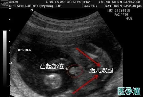 早期孕囊形状看性别图片圆形是男孩这个说法准吗数据对比一目了然