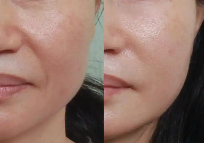 嘴角边的"杀手",显老又显胖的木偶纹_皮肤松弛_治疗介绍_介绍 - 好