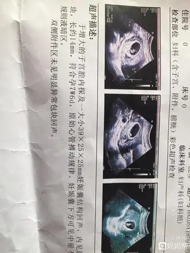 女b超单上有暗示孕囊看男女  1孕囊大小看男女其实看孕囊很准有传言说