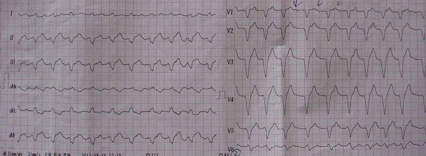 肺源性心脏病人的心电图病人已抢救无效
