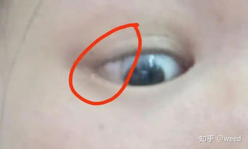 我眼睛里长了皮样脂肪瘤和大家分享一下我从检查到手术自己术后恢复的