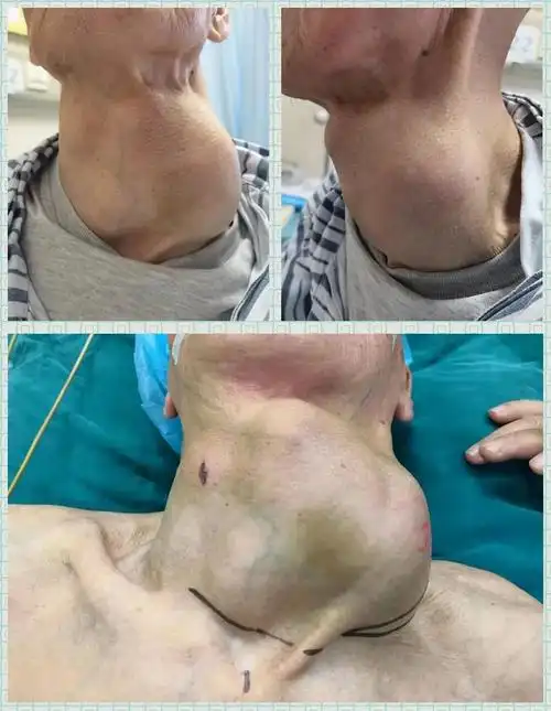 徐大爷颈部包块已增至直径10cm大小,这样尺寸的巨型甲状腺瘤是很少见