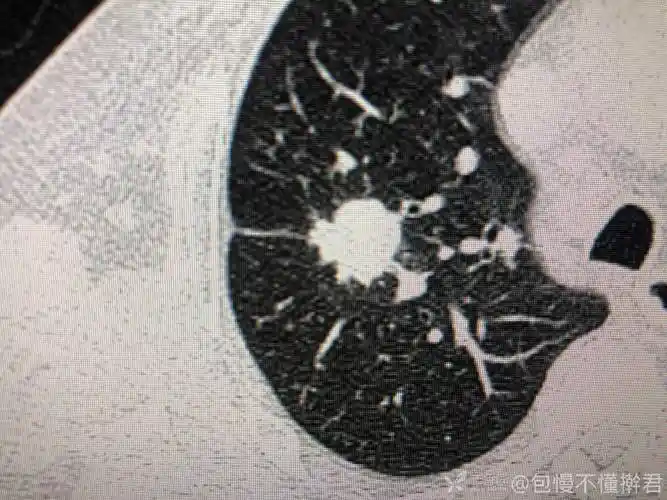 肺结节伴有钙化咯血肿瘤结核