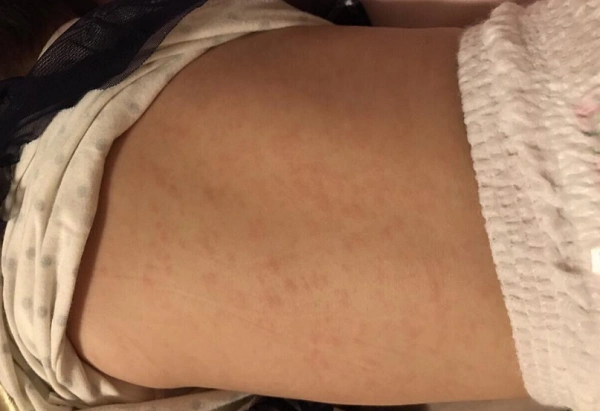 大家有没有自家孩子高烧后浑身起疹子的图片啊