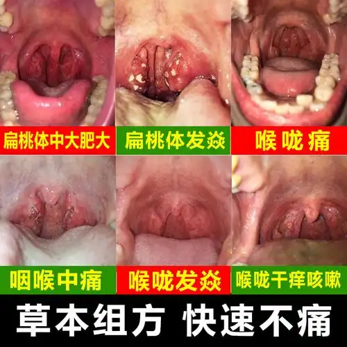 共68 件扁桃体肿大喷剂相关商品