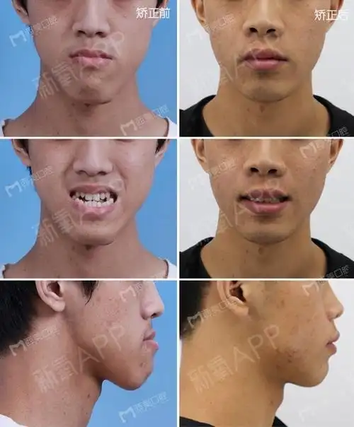 上颌骨发育不足下颌骨发育过度唇部和颏部偏斜面型过长上牙列重度拥挤