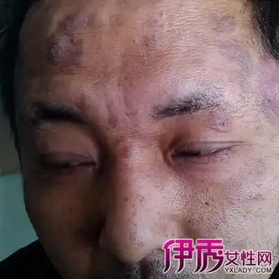 【图】男性霉菌炎症状图片大全 男性霉菌炎有什么危害?