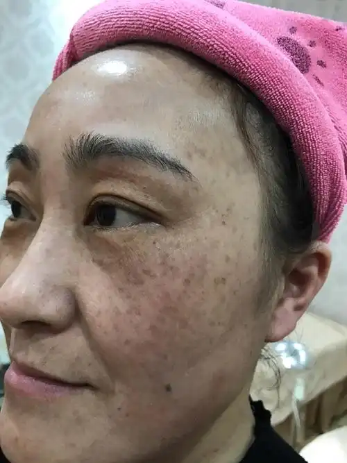 脸上的真皮斑怎么办 脸上的真皮斑是怎么形成的