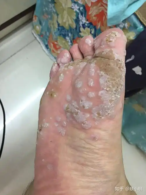 【慎点】脚上长了10年的疣会是什么样? - 知乎
