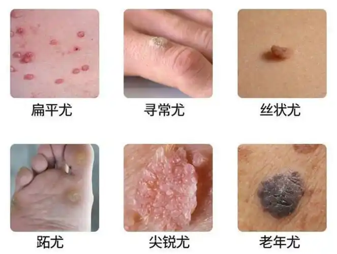 扁平疣"手上长了"瘊(hou)子"经常听别人说不仅影响美观,还有疾病的