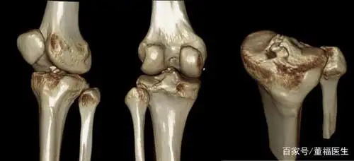 膝盖的胫骨平台骨折
