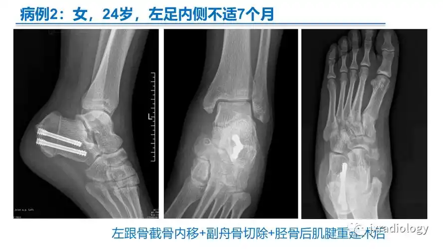 足副舟骨分型及相关病变的影像表现
