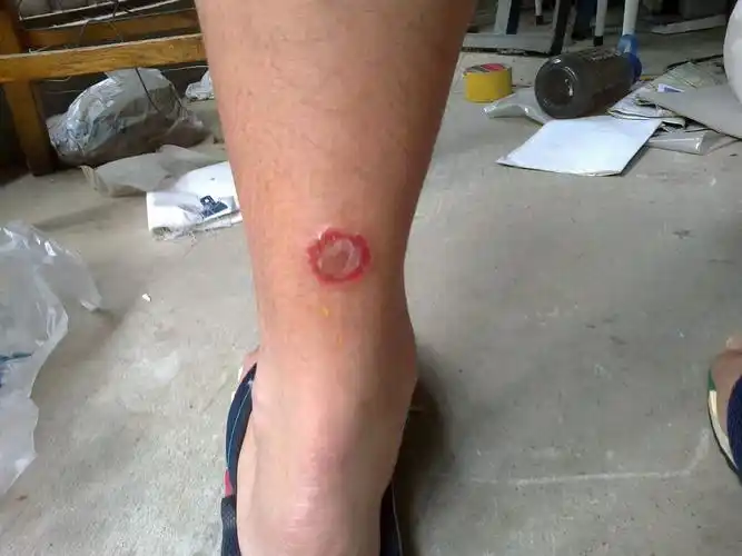 谁知道怎么治一下,碘酒和酒精都用过,不管用!