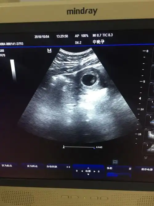 热乎乎的胎心胎芽