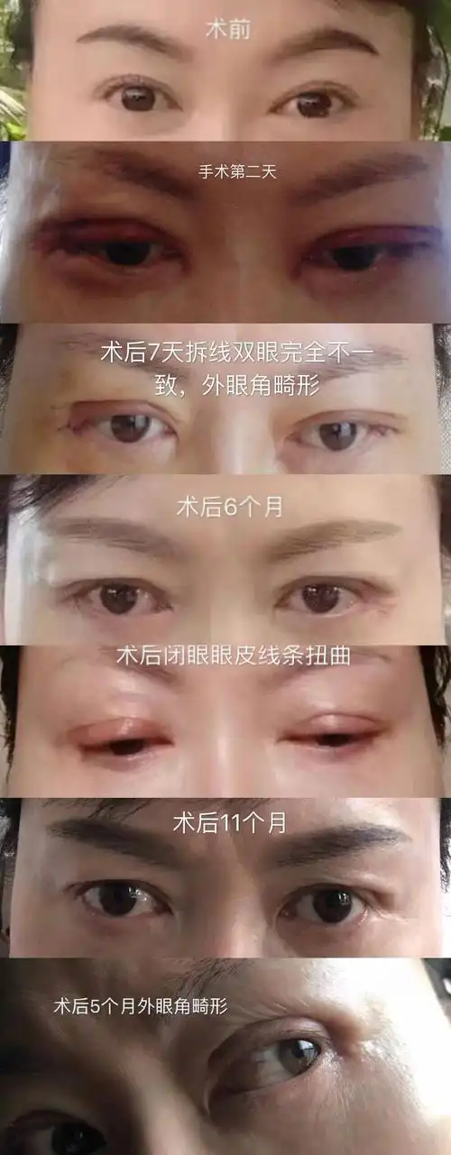 何芳(化名)的眼部整容前后对比图.受访者 供图