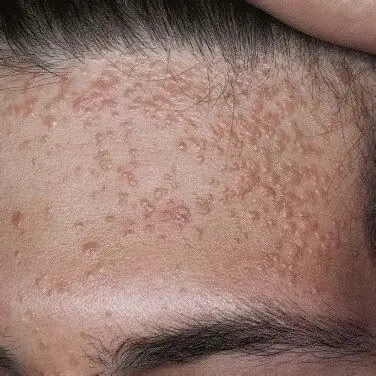 面部泛发性扁平疣的治疗_扁平疣