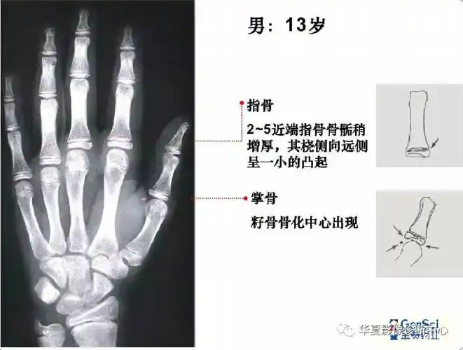 有了这张骨龄图轻松了解孩子的成长情况