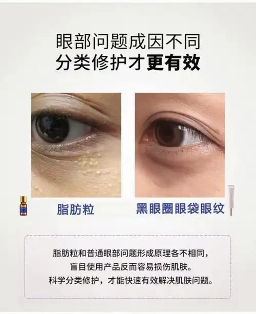 它来啦去眼部脂肪粒涂剂60