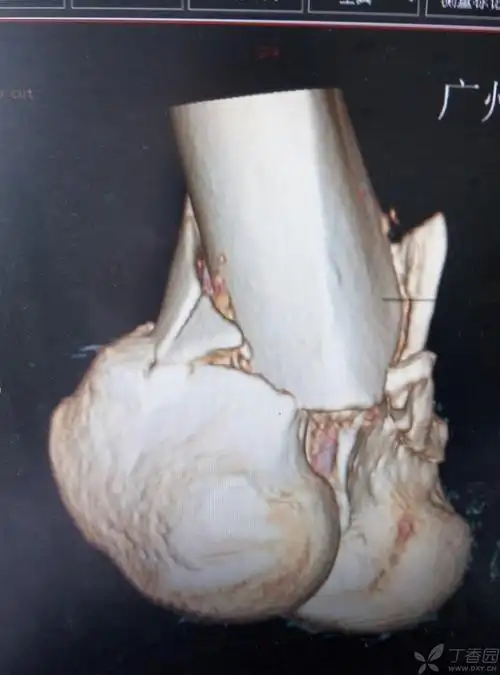 股骨髁间粉碎性骨折一例