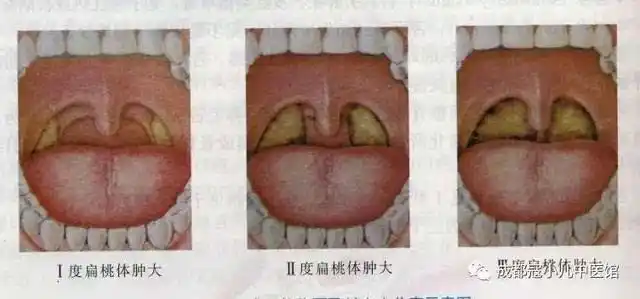 临床上将扁桃体肿大分为三度,不超过咽腭弓为i度肿大,超过咽腭弓为ii