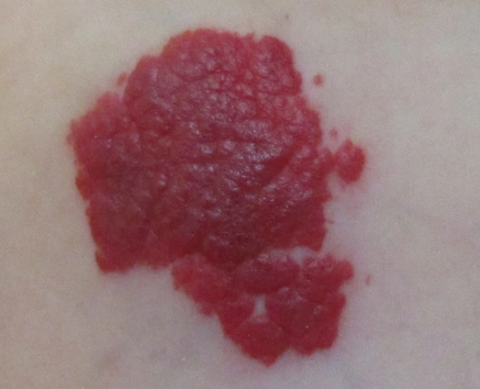 毛细血管瘤图片是什么样子的?