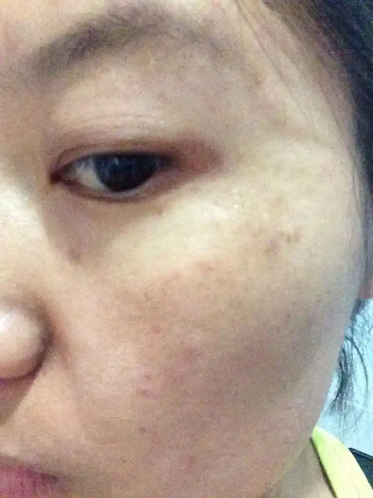 生完女儿长了妊娠斑,怎样可以去掉