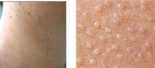 丝状疣的对比图片