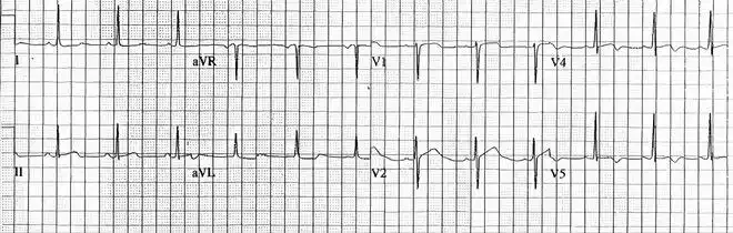 心电图上单一导联st段抬高是否也能提示急性心肌梗死
