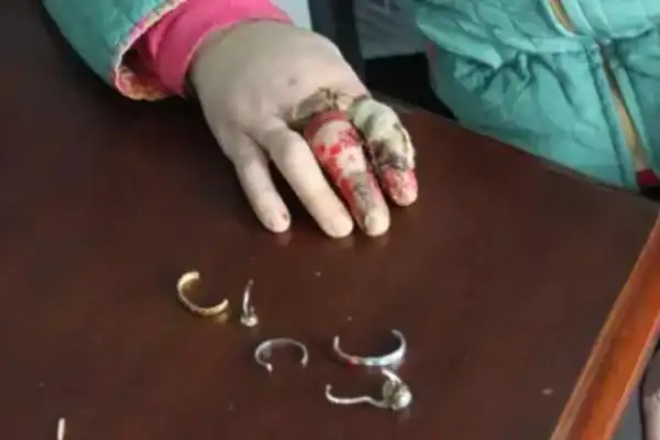 戴戒指打保龄球不安全手上的肉可能刮掉同时损坏戒指