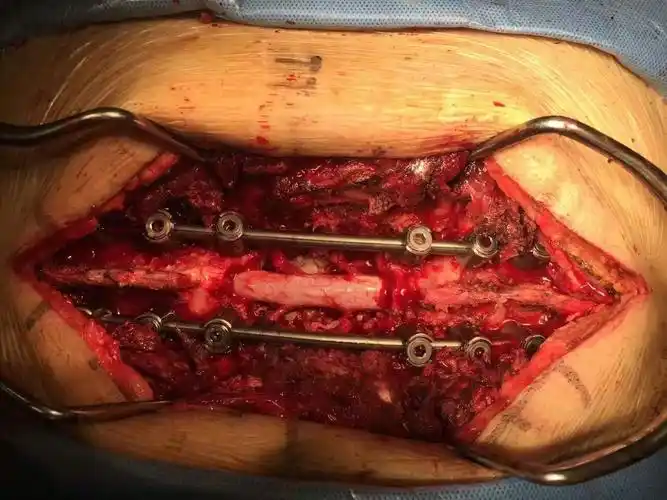 微创经椎间孔入路椎间融合术(mis-tlif) - 好大夫在线