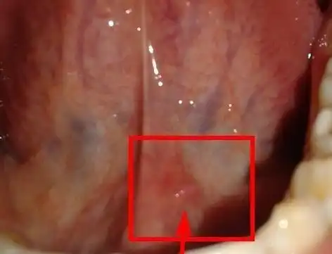 舌底上长了一个类似小舌头的疙瘩怎么办