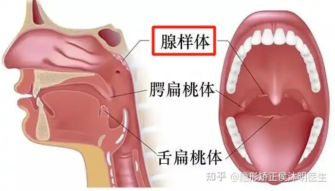 孩子有"腺样体面容"会影响智商和颜值! - 知乎