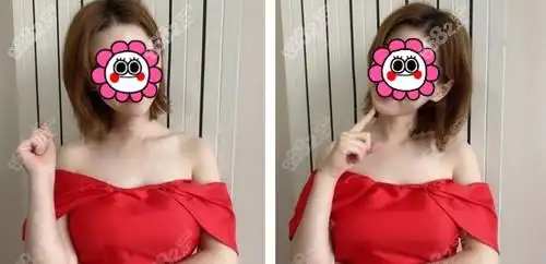 花7万多在北京韩啸做的棉花糖丰胸从效果看还挺靠谱的