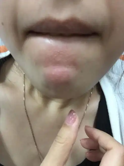 下巴老是长包 感觉像是上火 为什么老是长这里 目前还不是很疼