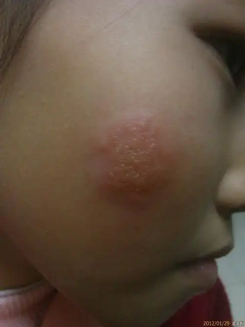 皮肤病脸部单纯疱疹