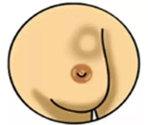 乳腺癌——女性恶性肿瘤的头号杀手,2步法,随时自查!