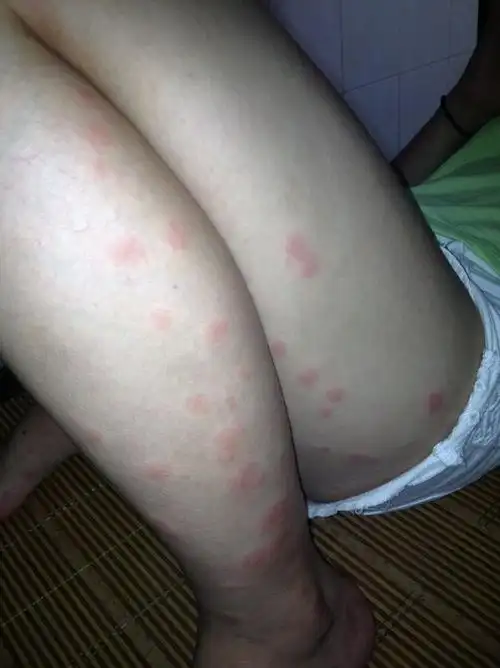 被臭虫咬了用什么药好?已经全身过敏,有图片,求大家帮助!