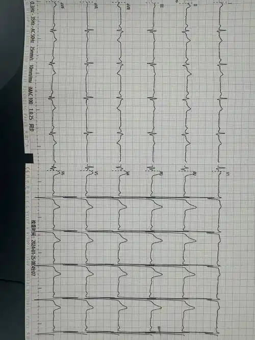 请问这个心电图是异常q波吗有梗吗
