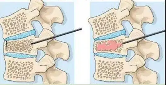 胸腰椎压缩骨折怎么办微创骨水泥注射椎体成型是好办法