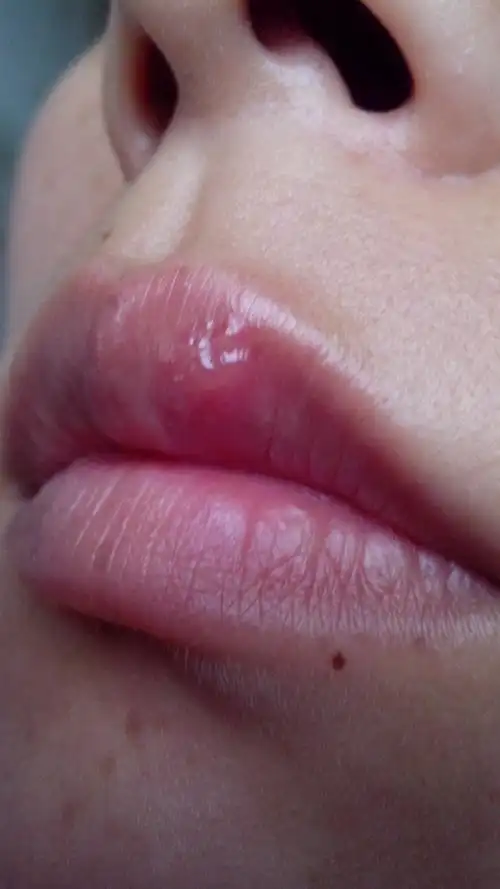 轻度儿童嘴唇疱疹感染图片