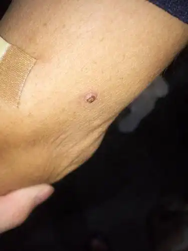 手臂上长了这个东西,不知道是什么.