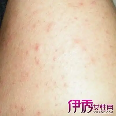 女性患梅毒症状有哪些