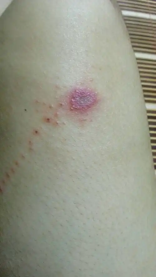 求问这个会不会是恙虫伤口,周围有一串的红疹之类的